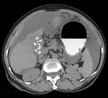 Figure 5: Gallbladder mass associated with large hyperdense calculus. Gross omental deposits and ascites can be seen. Inferiorly on right side the colon is invaded.